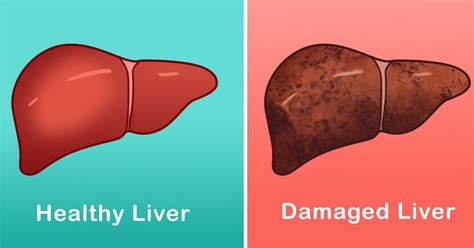 critical signs  liver disease liver disease liver liver failure