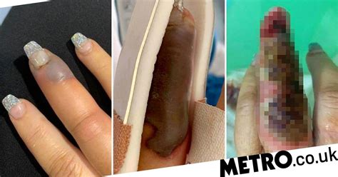 Woman S Finger Swelled And Turned Black After Getting A Salon Manicure