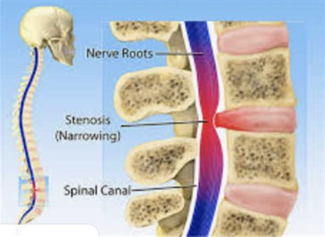 pain   hip arthritis  lumbar spinal stenosis