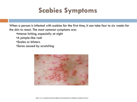 ppt what is scabies powerpoint presentation id 2457230