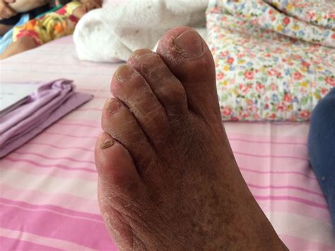 diabetic feet neuropathy ayurvedic treatment  royal ayurveda