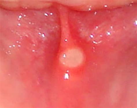 How To Get Rid Of Canker Sores 10 Proven Home Remedies
