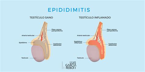 clínica garcíareboll on twitter la epididimitis es la inflamación