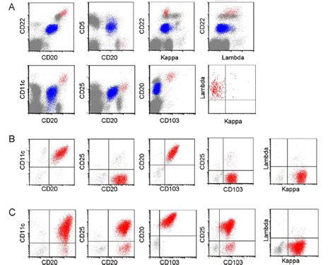 a flow cytometry analysis demonstrating coexistent hairy cell