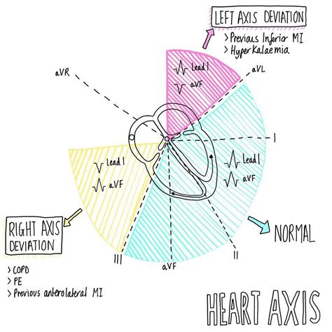 axis deviation common  exams science notes illustration heart medic medschool