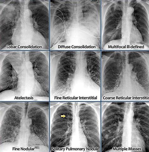 Chest X Ray Interpretation Medizzy