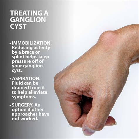 ganglion cysts information florida orthopaedic institute