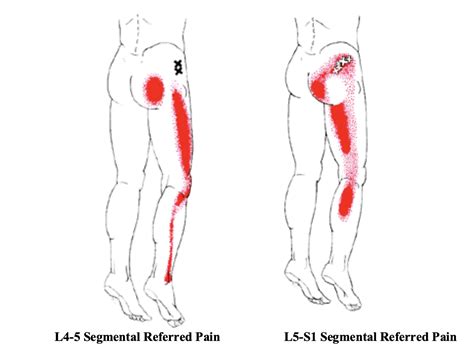 diagnosing lateral thigh pain  band syndrome hip bursitis