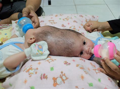 Nadira And Nadiba Conjoined Twins In Indonesia To Have