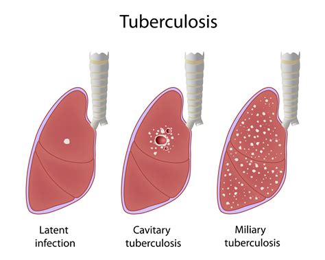 facts  tuberculosis symptoms vaccine  treatment urgent