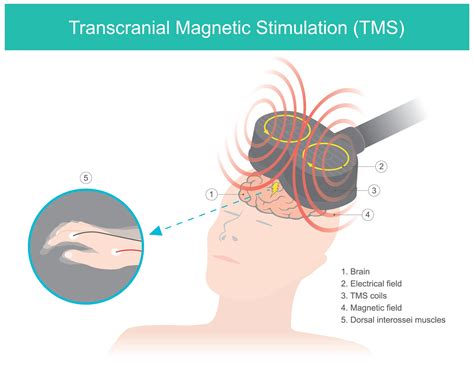 transcranial magnetic stimulation doctors   willa hammonds