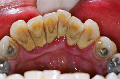dental plaque  main   dental caries intelligent dental