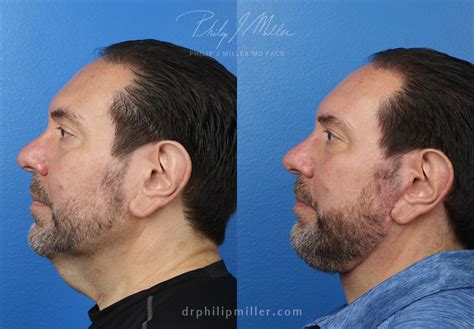 facts  male facelift  didnt  philip miller md