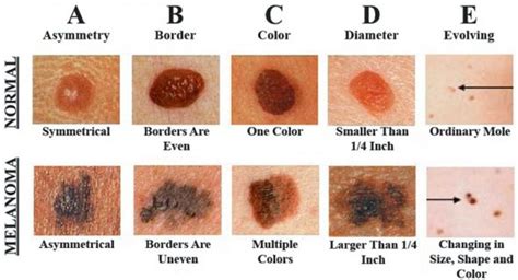 early signs  skin cancer skin