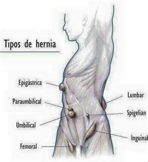 hernia  types symptoms locations pictures  treatment nigerian health blog