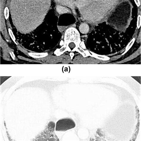small bowel involvement  systemic sclerosis  axial ct image shows  scientific