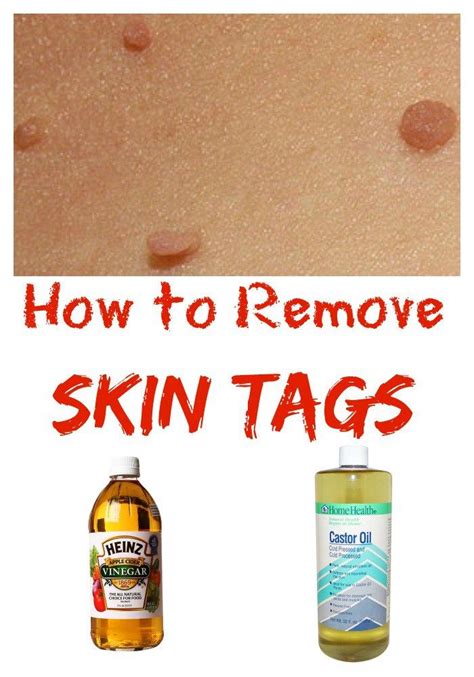 the 25 best skin tag on eyelid ideas on pinterest skin tags on face remove skin tags