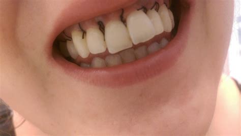 stitches dissolve  wisdom teeth removal teethwalls