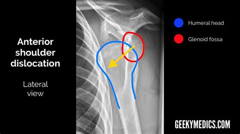 shoulder  ray interpretation radiology geeky medics