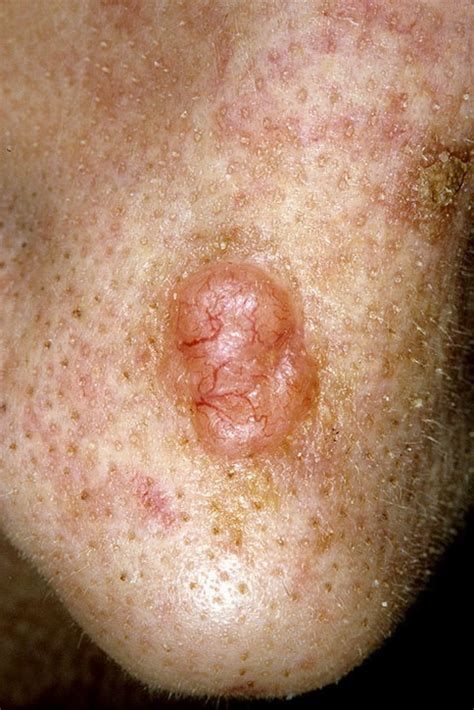 basal cell carcinoma nose pictures 54 photos and images