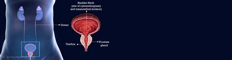 Bladder Neck Incision Indications Types And Complications