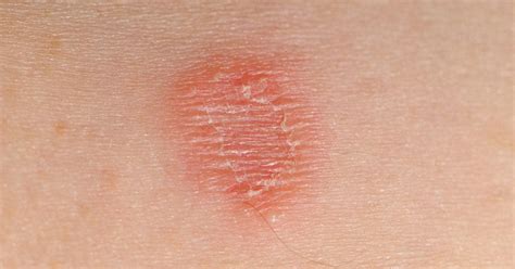 skin lesions pictures treatments