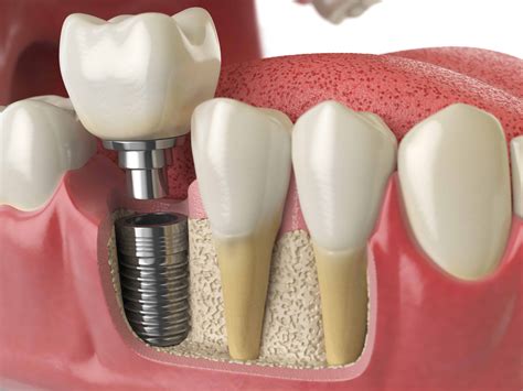 dental implants borough dental care call
