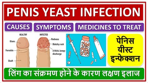 Penis Yeast Infection Treatment And Medicine Yeast Infection In Male