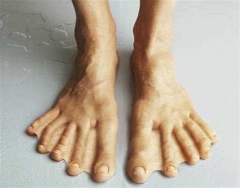 webbed toes  diagnosis surgery  pictures
