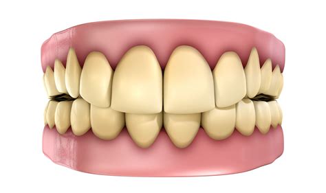 tooth discoloration troy mi