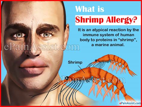 What Is Shrimp Allergy Know Its Causes Signs Symptoms Diagnosis Hot