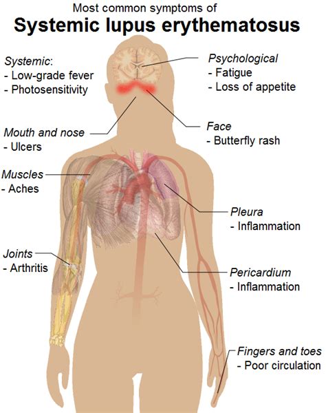 Systemic Lupus Erythematosus Causes Symptoms Treatment Systemic