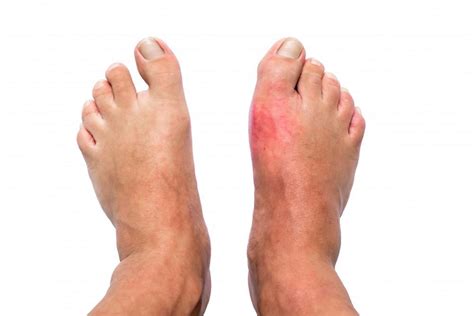 Help Is That Pain In My Toe Gout Rheumatology Center Of New Jersey