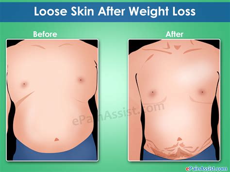 loose skin  weight lossnon surgical surgical ways  tighten excess skin