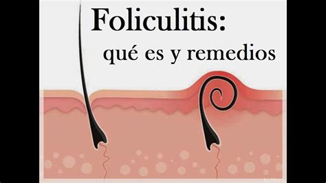 foliculitis qué es remedios youtube
