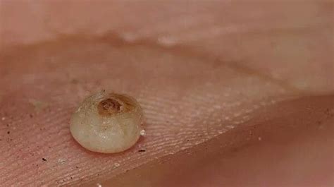 chigoe flea sand fleas human feet tiki torches skin diseases burrow