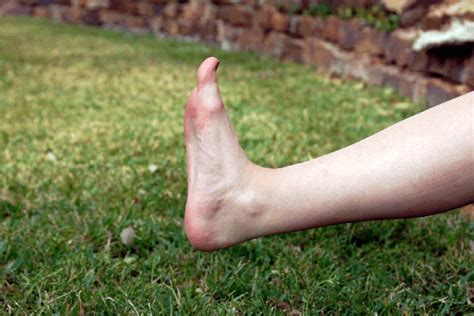 6 exercises for swollen feet and ankles livestrong