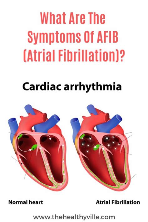 Signs Of Atrial Fibrillation Symptoms Hot Sex Picture