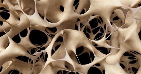 Osteoporosis Six Common Misconceptions 1010 Park Place
