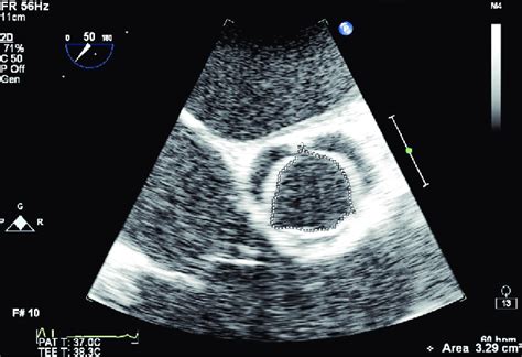 A Planimetry Of A Normal Aortic Valve Area In The Me Av