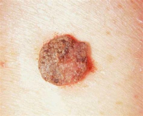 seborrheic keratosis pictures symptoms treatment removal   images   finder