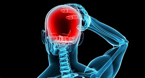 types of headaches migraine tension cluster