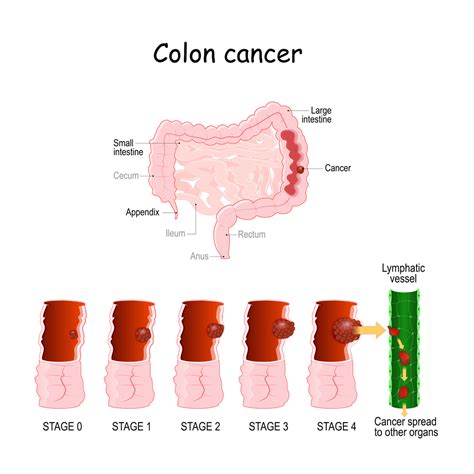 Colorectal Cancer Progression