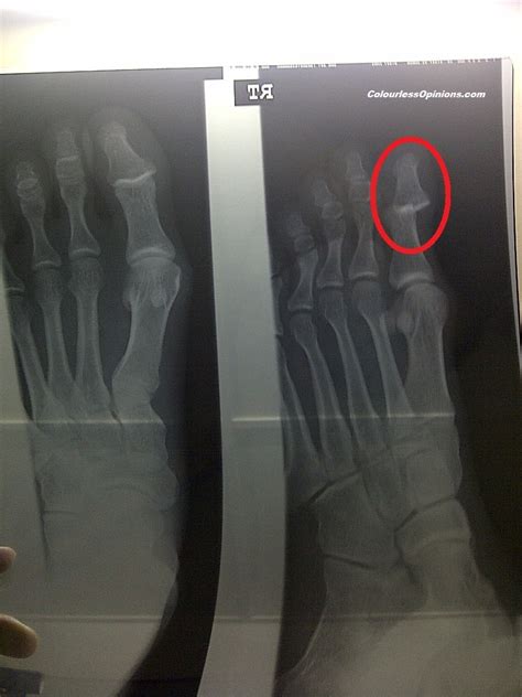 dislocated big toe treatment  sunway medical centre parantos