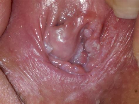 why is my pussy itchy 154084 have a lot of white cluster