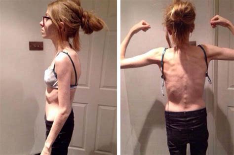Girl Recovers From Life Threatening Eating Disorder After