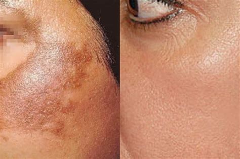 pigmentation removal skin clinic negombo