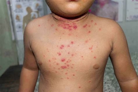 monkey pox   impact  children pregnant moms microbioz india