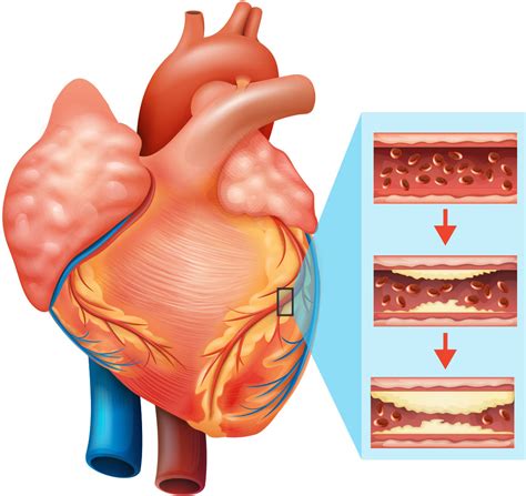 closer   heart disease risk harvard health