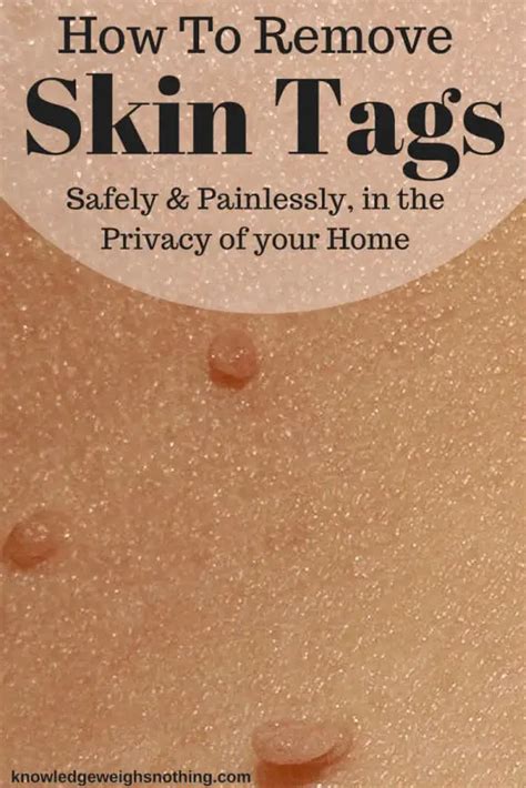how to remove skin tags at home tagband and home remedies